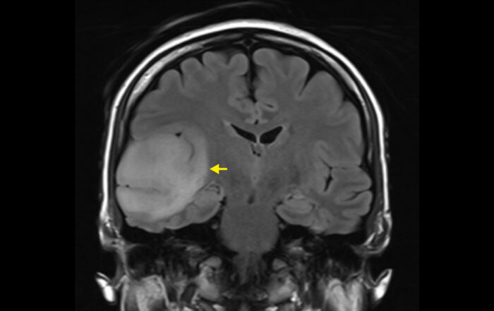 Neuroradiology Techniques for Brain Tumor Detection