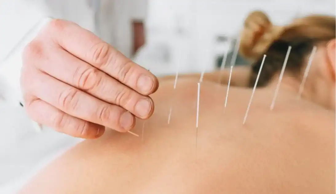 Acupuncture Techniques for Pain Management