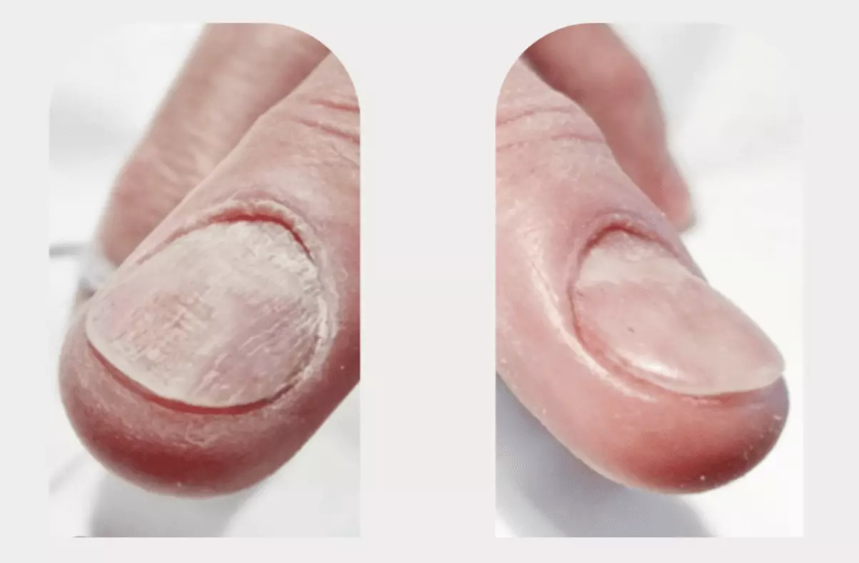 Tips for Preventing Fungal Nail Infections at Home
