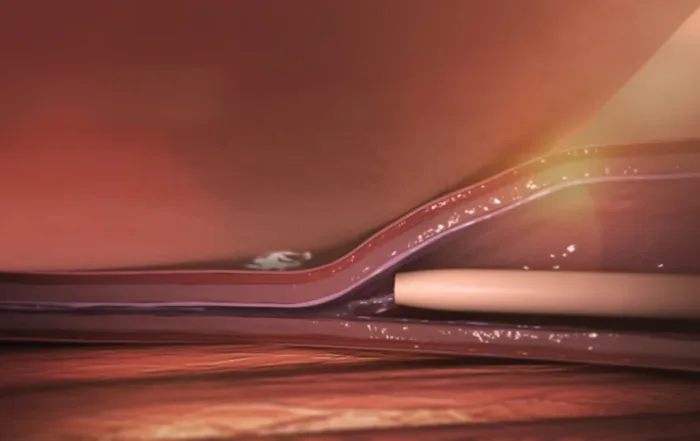 Exploring Treatments Options for Persistent Varicose Veins