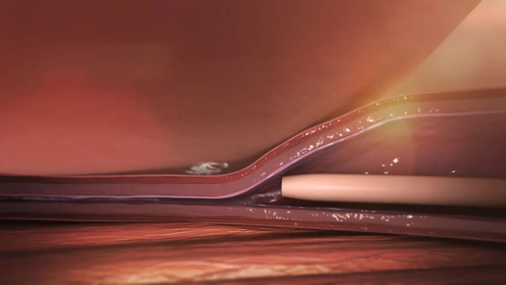 Exploring Treatments Options for Persistent Varicose Veins