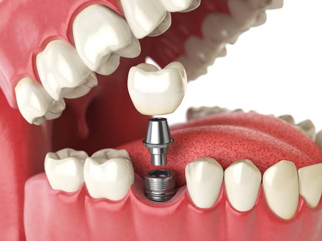 Understanding Dental Implants in Thayer, MO: Benefits, Risks, and What Locals Need to Know