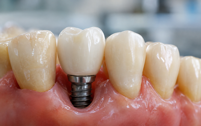 A Checklist for Choosing a Tooth Replacement Plan in Rapid City, SD Replacing a missing tooth is not simply a matter of choosing the newest-looking option. For people in Rapid City and across the Black Hills, the best plan should account for oral health, chewing needs, appearance goals, daily routines, budget, and the ability to maintain the result over time. Whether the concern is one visible tooth or an entire arch, a careful consultation can make the decision feel more manageable. For example, dental implants Rapid City SD, from Carpenter Dental outline how implant posts, abutments, and replacement teeth can work together to restore a single tooth, several teeth, or a full arch. As a Rapid City dental practice that provides implant placement and restoration options, Carpenter Dental offers a relevant local reference for patients comparing treatment stages, restoration types, and ongoing care near the Black Hills. Why Tooth Replacement Requires Careful Planning A missing tooth can affect how a person chews, speaks, smiles, and cleans around nearby teeth. Yet appearance is only one part of the decision. The condition of the gums, jawbone, neighboring teeth, and bite all help determine which choices may be appropriate. Patients should also know why the tooth was lost. Decay, gum disease, injury, grinding, and older dental work can each raise different planning questions. A replacement should address the current gap without overlooking active disease or teeth that may still be saved. The American Dental Association encourages patients to discuss the diagnosis, available alternatives, and treatment questions before making decisions about complex care, including implants. Before committing to a major procedure, it is reasonable to ask for a clear explanation, take time to review the plan, or seek a second opinion. This can be especially helpful when a recommendation involves removing teeth, multiple surgical steps, or a large financial commitment. The Main Tooth Replacement Options Replacing One Missing Tooth A single missing tooth may be replaced with an implant-supported crown, a traditional bridge, or a removable partial denture. An implant-supported crown uses an implant post in the jaw to support one replacement tooth. A traditional bridge commonly relies on neighboring teeth for support, while a partial denture is removable. The condition of adjacent teeth matters. If nearby teeth already need crowns, a bridge may be part of the conversation. If they are healthy, patients may want to ask how each option affects them. It is also useful to ask what may happen if replacement is delayed and whether a temporary tooth is available during treatment. Replacing Several Teeth For several missing teeth in a row, possibilities may include an implant-supported bridge or a removable partial denture. One implant is not necessarily needed for every missing tooth. The number and placement of implants, if recommended, depend on the location of the gap, available support, bite forces, and the planned restoration. Compare each option in practical terms: stability while eating, appearance, ease of cleaning around it, repair needs, and whether it can be removed at home. A solution that looks appealing but cannot be cleaned consistently may not be the best long-term fit. Replacing a Full Arch Full-arch replacement may use several implants to support either a fixed restoration or a removable overdenture. These plans can involve extractions, temporary teeth, healing periods, and a final restoration. Bone volume, gum health, bite pressure, medical history, and hygiene ability all need to be reviewed before treatment begins. Seven Questions to Ask During a Consultation What caused the tooth loss?Understanding the cause can shape gum care, timing, and prevention plans. Can any damaged teeth still be saved? Ask whether restoration is possible before agreeing to extraction. What images or tests are needed?X-rays, scans, and clinical examinations may be used to plan treatment. Which fixed, removable, and implant-supported options fit my situation? Request an explanation of reasonable alternatives. What will recovery involve? Ask about healing, food restrictions, work schedules, and temporary replacements. How will I clean the replacement every day? Cleaning instructions should be realistic for your routine. What happens if the plan changes?Ask about additional procedures, delays, repairs, and possible added costs. How Health History Can Affect Treatment Bring a current medication list and share relevant medical history. Gum disease, tobacco use, diabetes, bone health concerns, dry mouth, and teeth grinding can affect planning, healing, or maintenance. No online checklist can determine whether someone is a candidate for a particular procedure. That decision requires an in-person dental examination and an individualized discussion. Daily care remains important after any replacement. Regular brushing and cleaning between teeth help control plaque around natural teeth, gums, crowns, dentures, and other dental work. Ask the dental team whether threaders, interdental brushes, water flossers, or other tools are appropriate for the restoration under consideration. What a Written Estimate Should Include A starting price rarely shows the full scope of treatment. Request an itemized written estimate that separates planned services, such as: Examinations, X-rays, scans, and diagnostic planning Extractions, gum treatment, or other disease control Implant surgery, bone grafting, or related preparation when needed Abutments, crowns, bridges, dentures, or full-arch restorations Temporary teeth, sedation, follow-up visits, and adjustments Expected maintenance, repairs, or replacement of worn components How to Compare Two Treatment Plans Compare the scope of care, not just the total price. Use these points when reviewing estimates from different offices: Diagnosis: Do both plans address the same dental problem? Materials: What type of crown, bridge, denture, or prosthesis is included? Timeline: How many appointments, healing stages, and temporary solutions are expected? Maintenance: How will the replacement be cleaned, checked, and repaired? Costs: Does the estimate include every planned stage, or are certain items listed separately? Alternatives: Were fixed, removable, and tooth-saving options discussed where appropriate? Provider and Long-Term Care Questions Ask who will perform each stage, whether surgery and restoration are coordinated by one team, and how urgent concerns are handled after treatment. Also ask about recall visits, professional cleanings, bite checks, and protection for grinding or clenching. Replacement teeth do not eliminate the need for routine oral care. Common Mistakes to Avoid Choosing treatment based on an advertised price alone. Assuming every missing tooth requires the same solution. Ignoring active gum disease or untreated decay. Failing to ask what is included in the written estimate. Overlooking temporary teeth, recovery time, and cleaning requirements. Agreeing to complex treatment without understanding alternatives. A Simple Decision-Making Checklist Before leaving a consultation, make sure you know which teeth are missing or damaged, what your main chewing and appearance goals are, which options are reasonable, what the timeline looks like, how the replacement will be cleaned, and what future maintenance may involve. A practical tooth replacement plan should make clinical sense and fit everyday life in Rapid City, SD.
